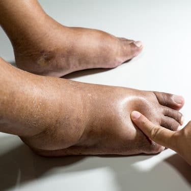 Mi okozhatja a láb- és kézdagadást? - HáziPatika