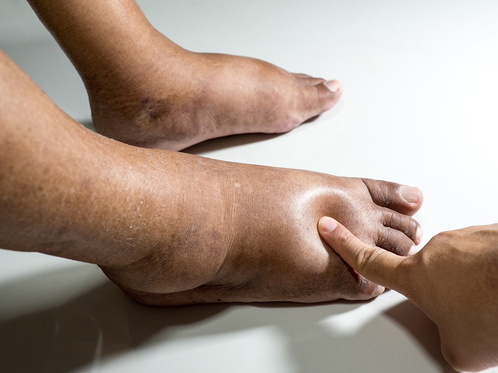 A lábdagadás leggyakoribb okai és kezelése | DrNatura-SuperGreens HU