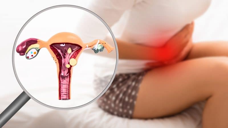 Endometrióza -Hormonálne zmeny vášho menštruačného cyklu ovplyvňujú nesprávne umiestnené tkanivo podobné endometriu, čo spôsobuje, že sa oblasť zapáli a bude bolestivá. To znamená, že tkanivo bude rásť, hrubnúť a rozpadať sa. V priebehu času sa tkanivo, ktoré sa rozpadlo, nemá kam dostať a uviazne vo vašej panve. Endometrióza je chronický stav, ktorý je idiopatický, čo znamená, že sa ešte musí určiť, čo ho spôsobuje. A momentálne nemá liek. K dispozícii sú však účinné liečby, ako sú lieky, hormonálna terapia a chirurgia, ktoré pomáhajú zvládnuť vedľajšie účinky a komplikácie, ako sú bolesti a problémy s plodnosťou. A príznaky endometriózy sa zvyčajne zlepšujú po menopauze.